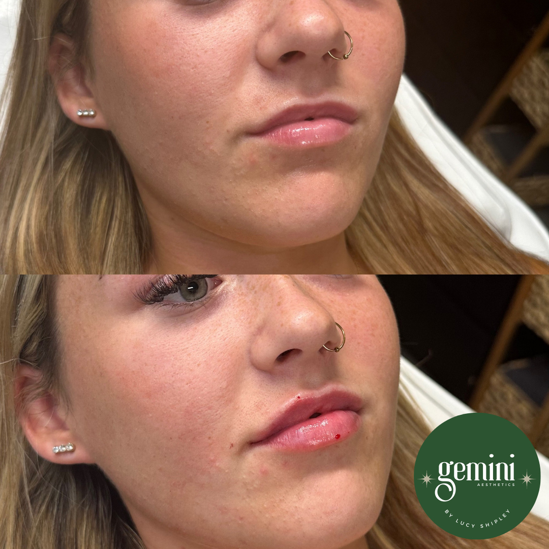 A woman with blonde hair and a nose ring showing before and after cosmetic lips and facial treatment, with the Gemini Aesthetics logo at the bottom right.
