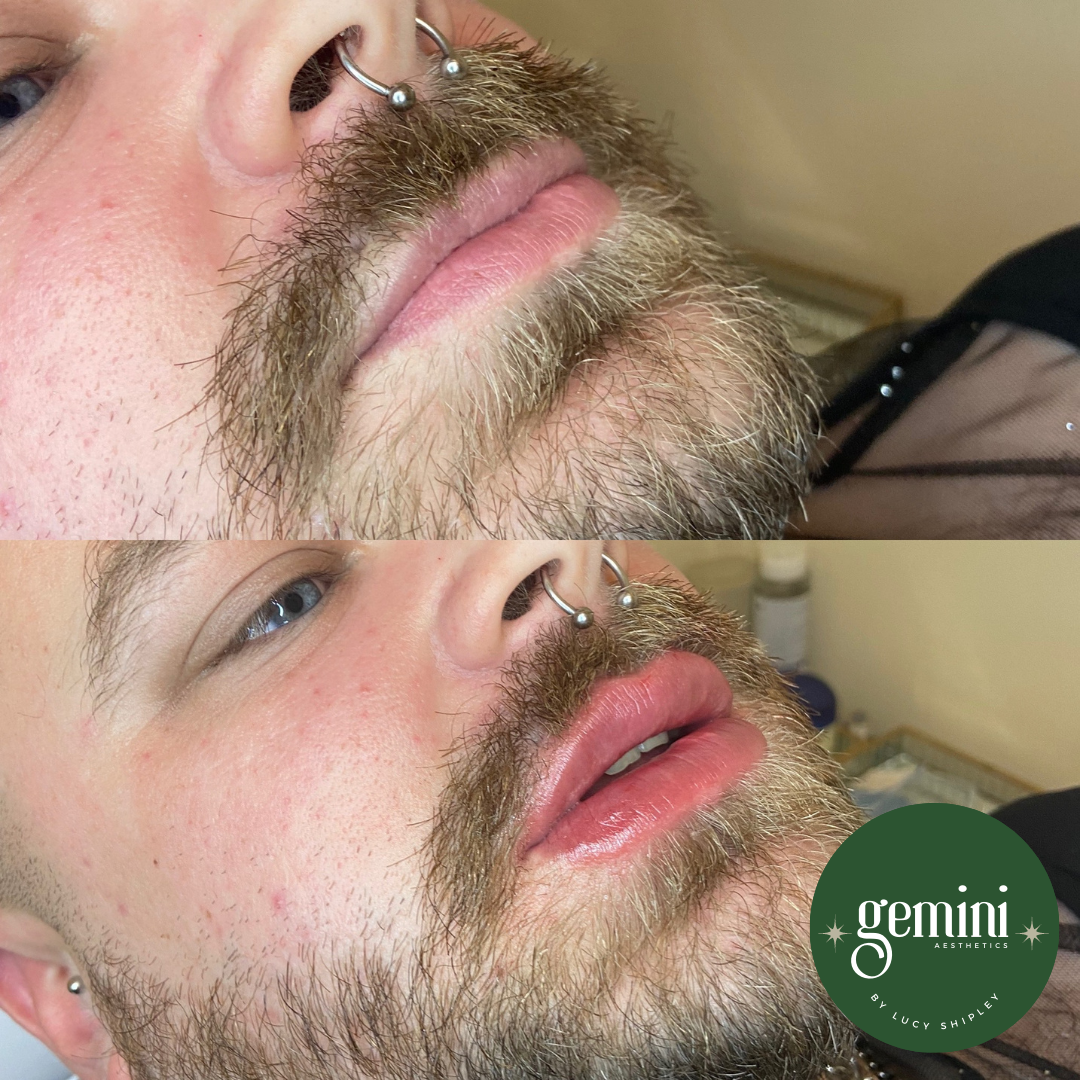 Close-up of a man's face before and after lip enhancement, showing fuller lips in the after photo, with facial hair, nose ring, and a background indicating a cosmetic treatment setting.