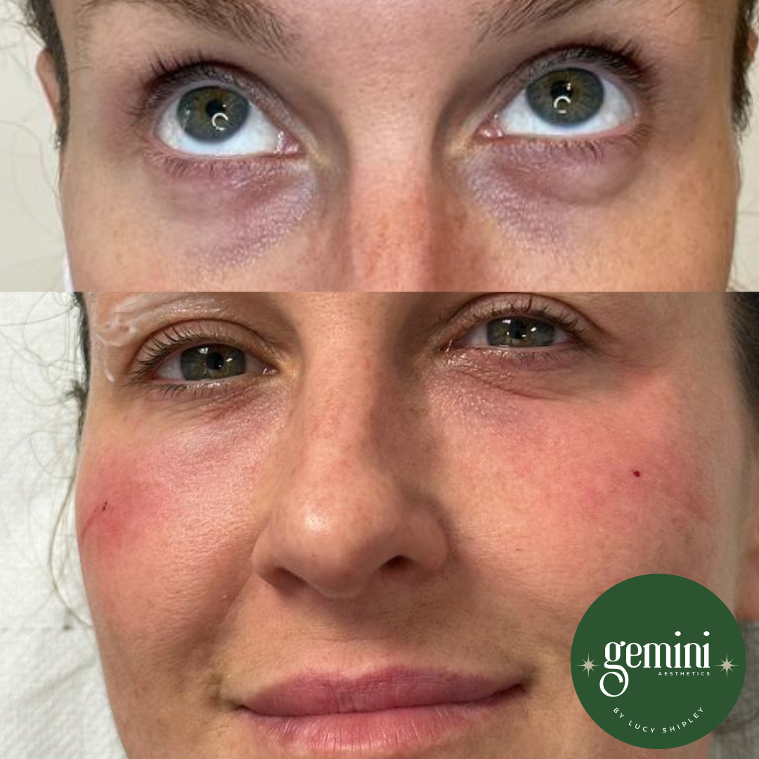Before and after images of a woman's face showing the area around her eyes, with noticeable reduction in dark circles and puffiness after a cosmetic treatment. The bottom right corner features the Gemini Aesthetics logo.