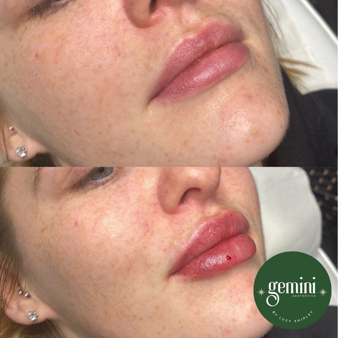 Close-up of a woman's face showing before and after lip enhancement, with the lips appearing fuller and more defined in the after photo, and a Gemini Aesthetics logo in the bottom right corner.