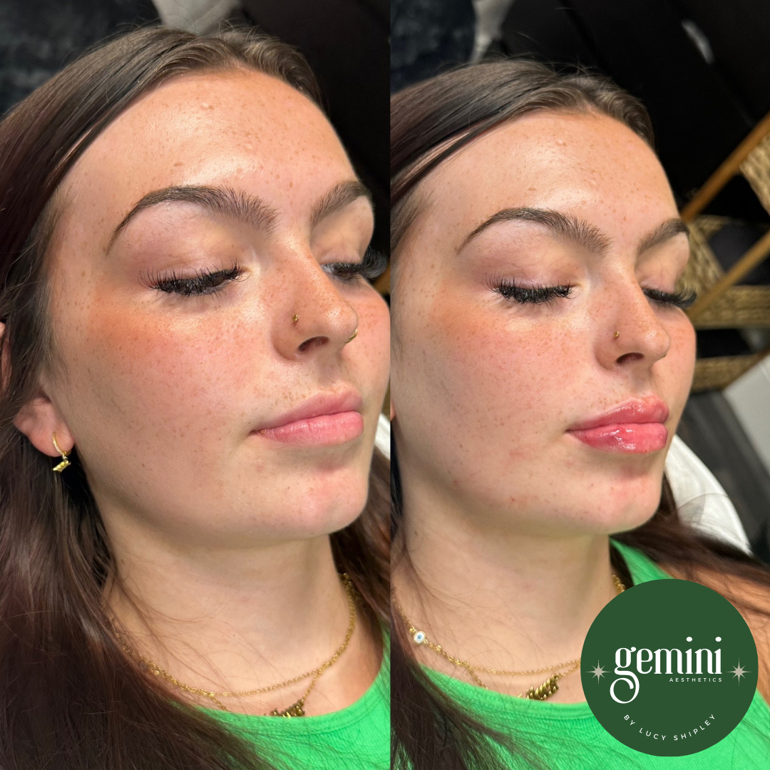Side-by-side comparison of a woman's face before and after cosmetic treatment, showing improved skin tone and lip gloss application.