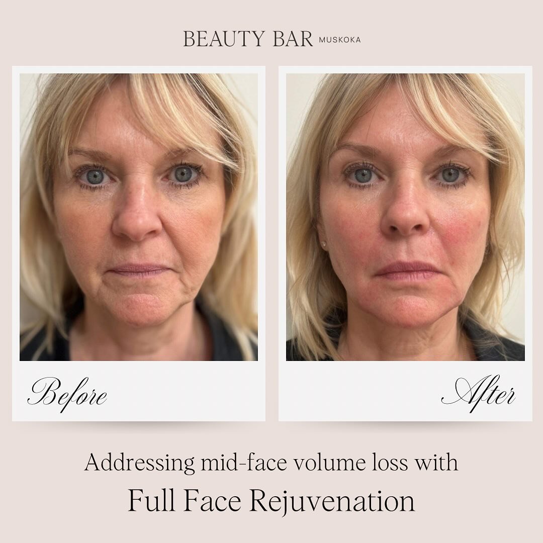 Our client had initially expressed her desire to have her nasolabial folds and marionette lines treated👇🏼

However&hellip; after some education on the aging process, and learning why addressing the face as a whole is important (ie. changes in one a