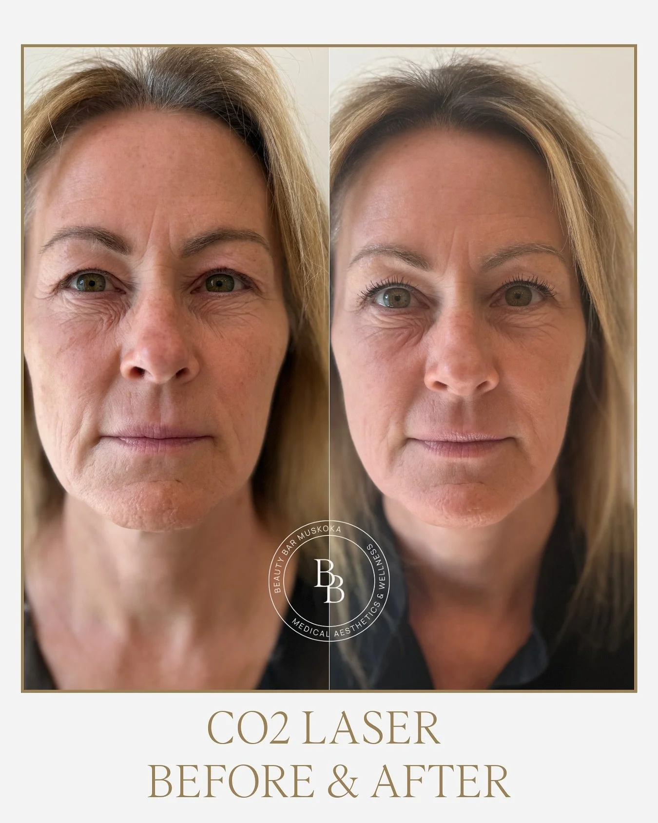 We&rsquo;re a little obsessed with our CO₂ laser results after just 1 treatment 🤯 

You don&rsquo;t need a magnifying glass to see a significant improvement in skin tone, texture, and even a reduction of fine lines.  And now, this powerful treatment