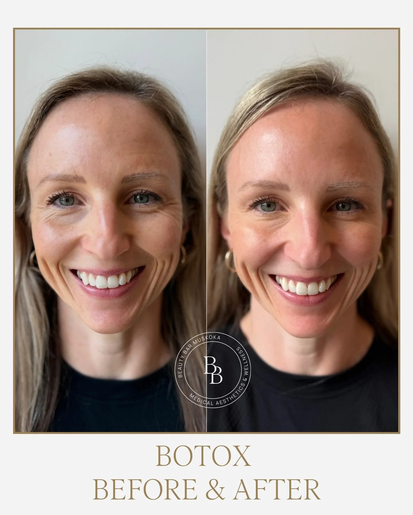 Forget what you&rsquo;ve heard about Botox ❌

Let us reintroduce you to what Botox really is:
✨ Subtle. Strategic. Expression-preserving.

👀 Just look at our lovely client, her skin is glowing, we can see a reduction in static and dynamic lines, and