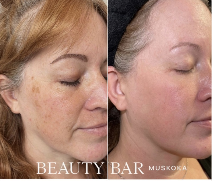 Laser Toning (3 treatments)