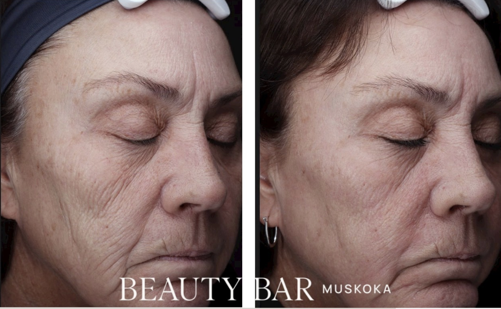 CO2 Laser Resurfacing (1 treatment)