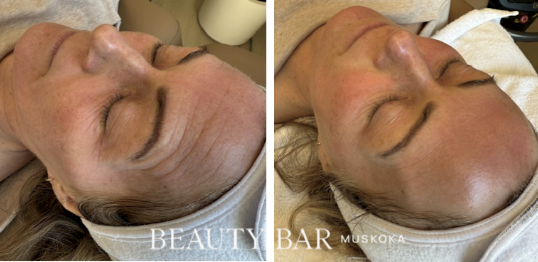 Hollywood Carbon Peel (1 treatment)