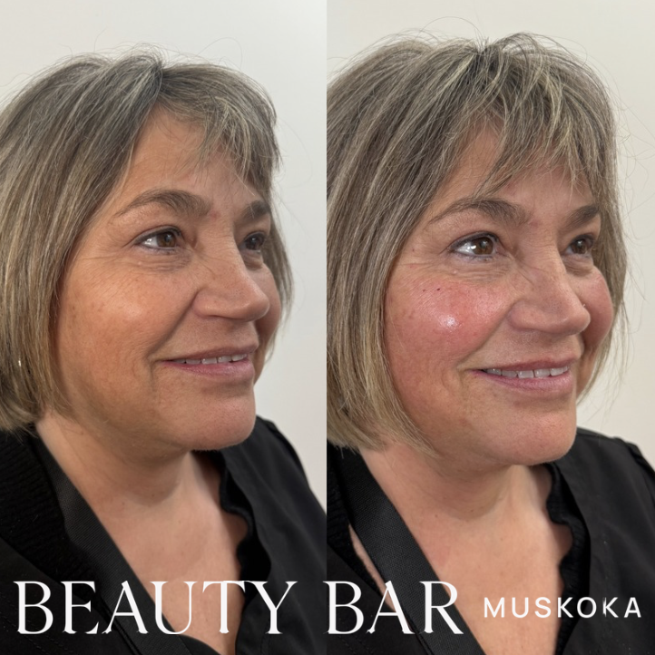Full facial balancing with dermal filler