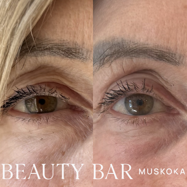 Non-surgical blepharoplasty with CO2 Laser Resurfacing