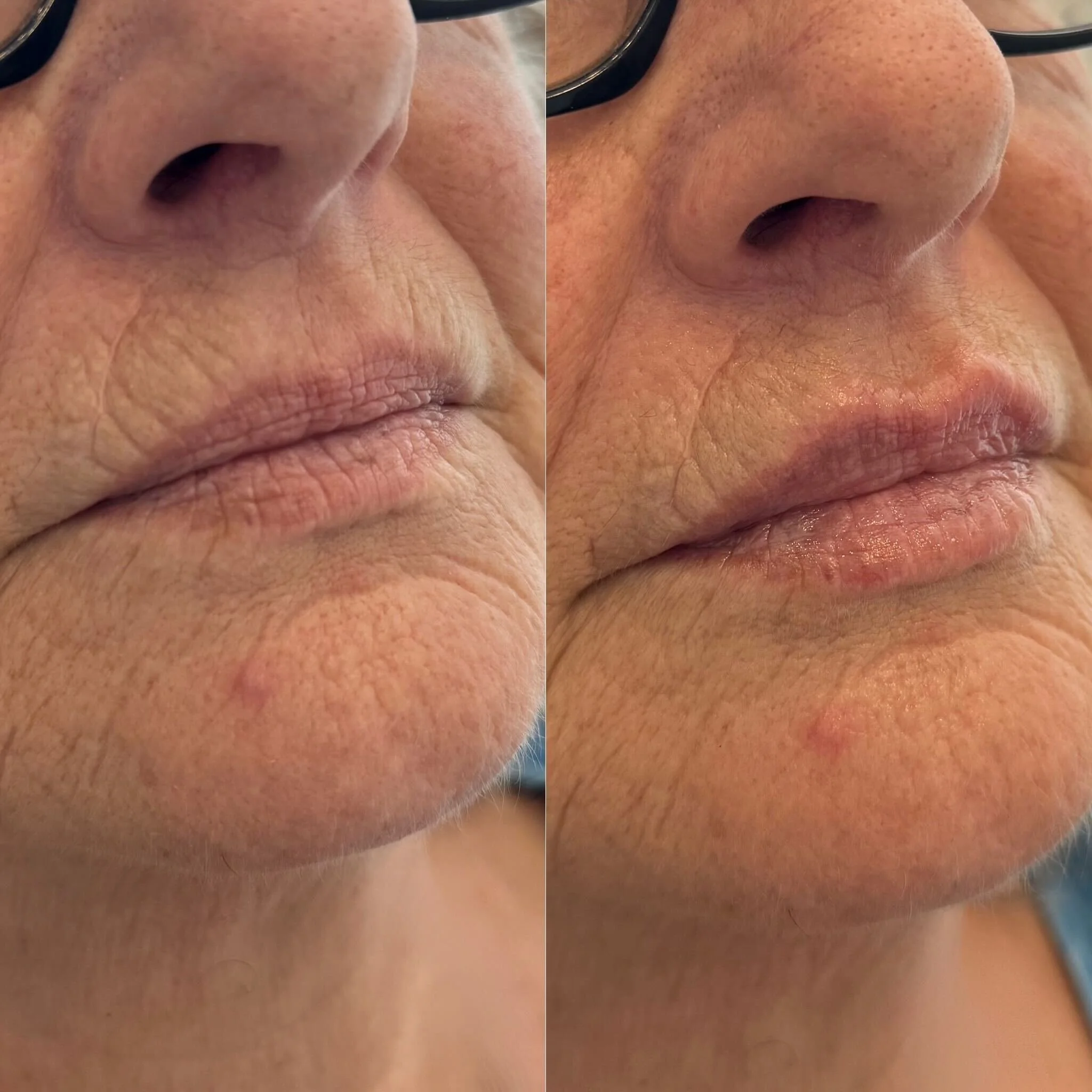 Hyaluronic Acid Lip Treatment