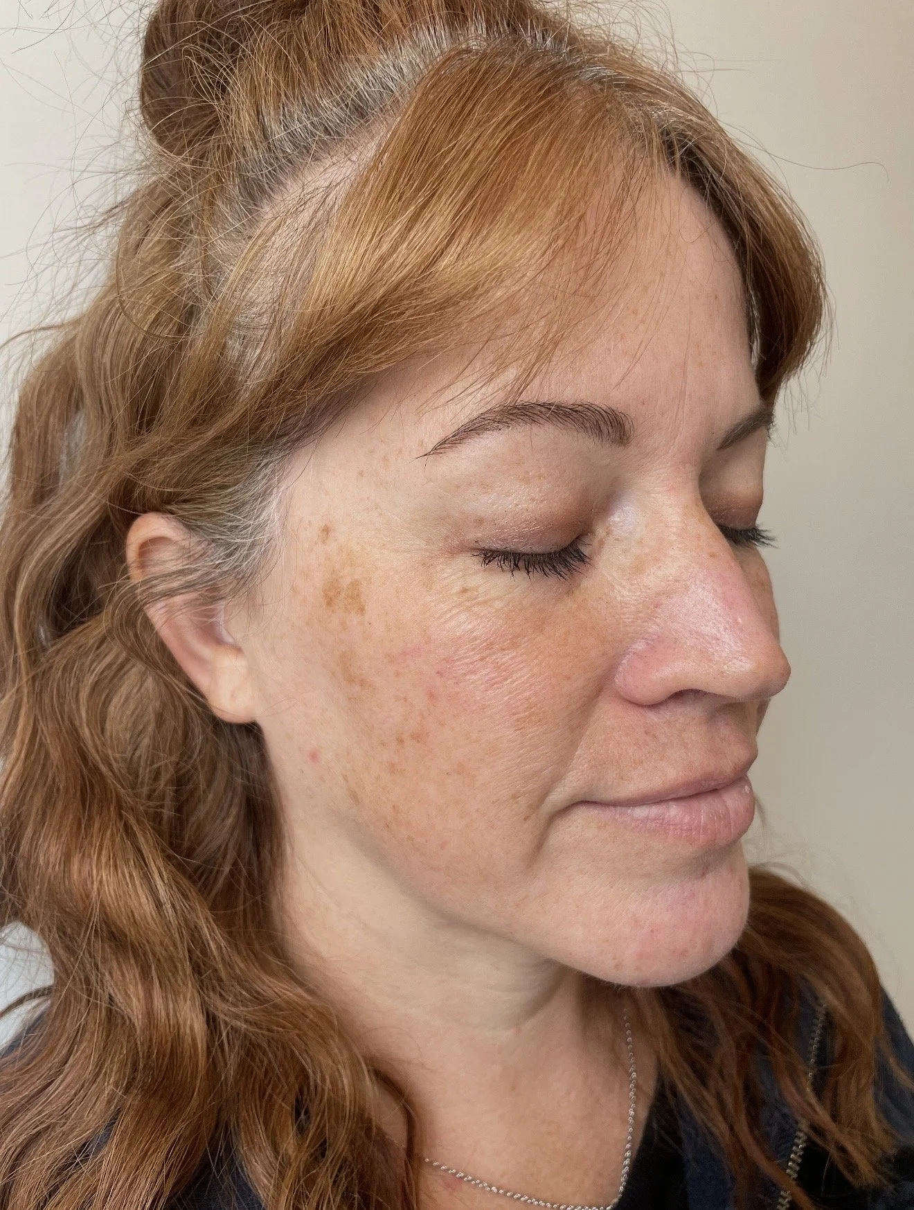 The Truth About Sun Damage: What Those Brown Spots Are Really Telling You
