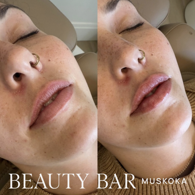 Lip filler to define borders and hydrate