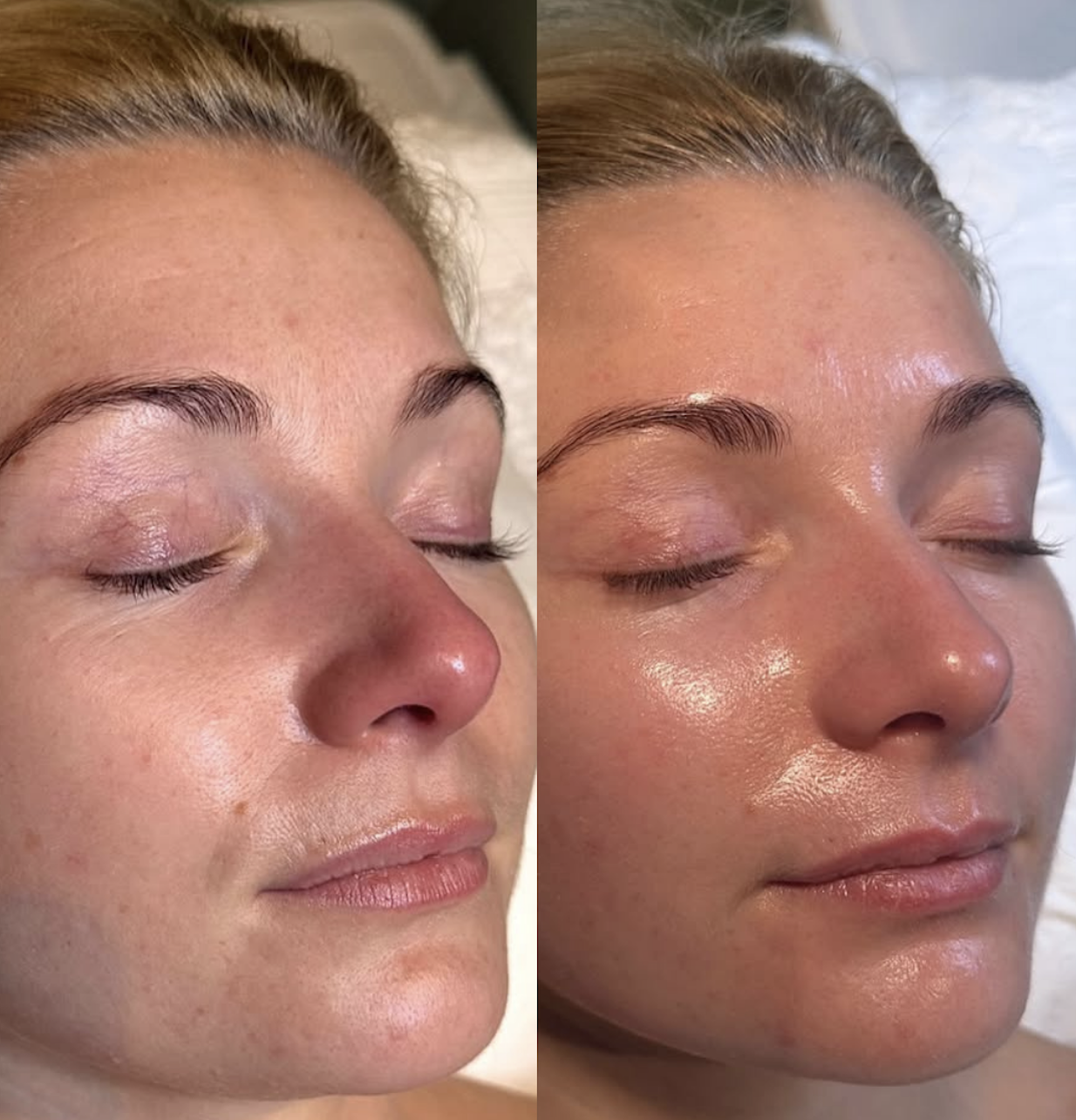 Chemical Peel (1 treatment)