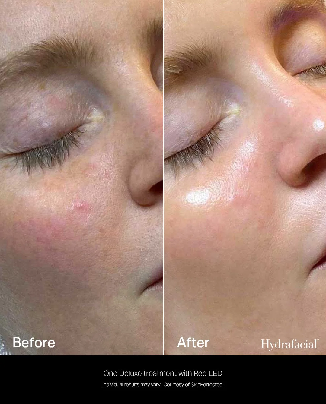 B/A HYDRAFACIAL