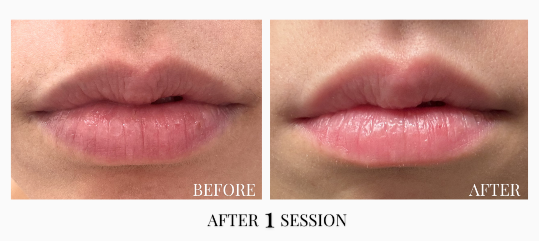 Aerolase Laser Lip Plump - Lumina Med Spa | Medical Spa Glendale CA