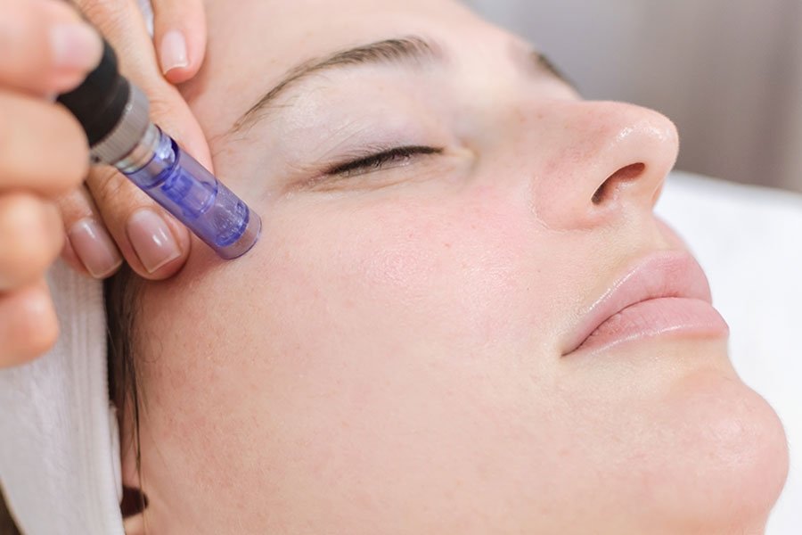 microneedling with pdrn