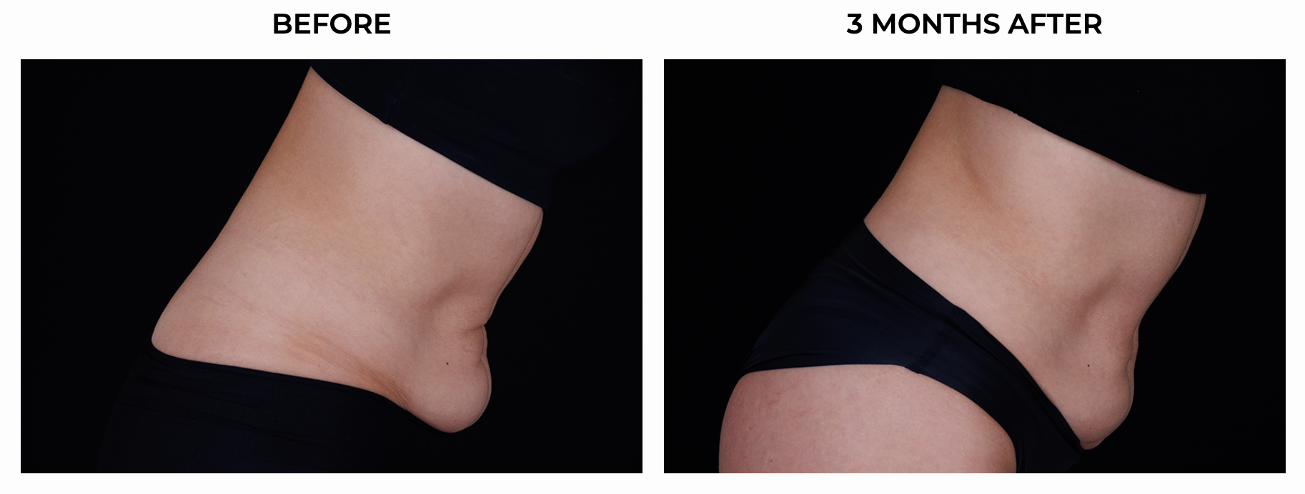 BA ULTHERAPY BODY 2.png