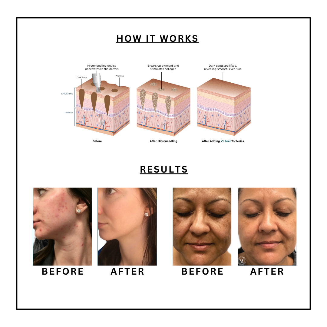 VI Peel and microneedling (1).png