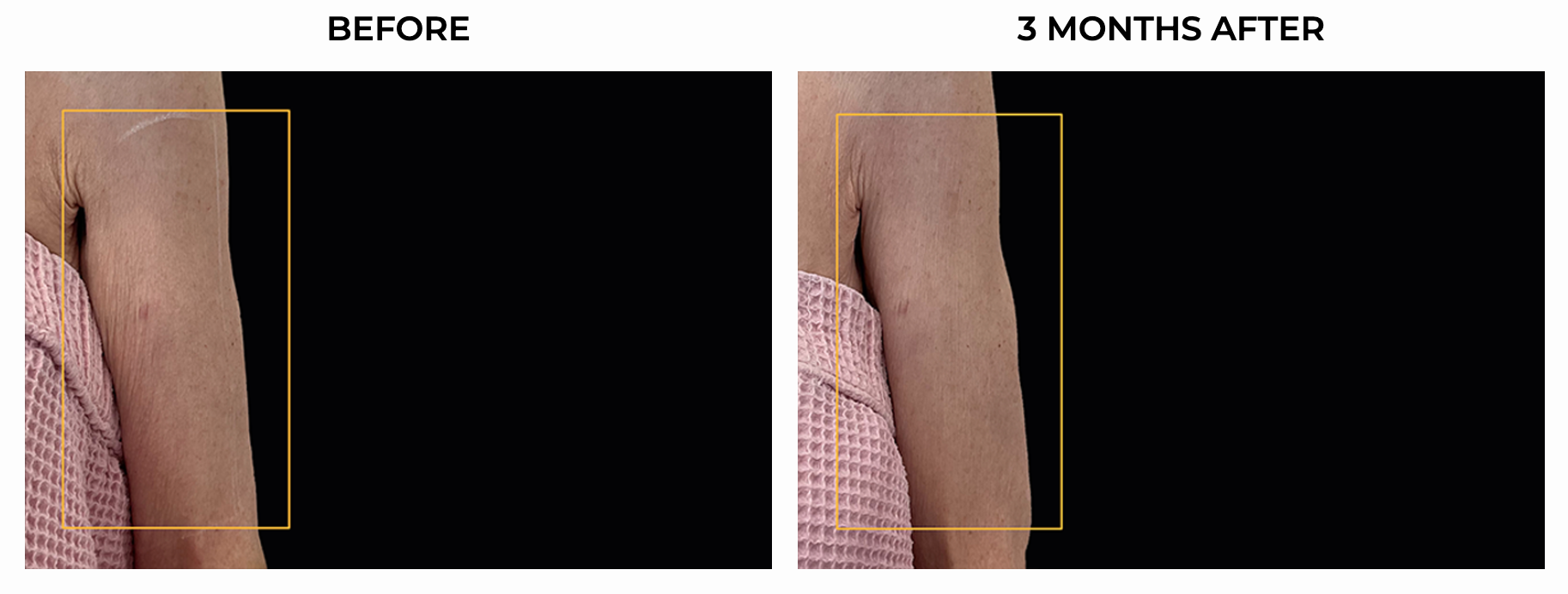 BA ULTHERAPY BODY 1.png