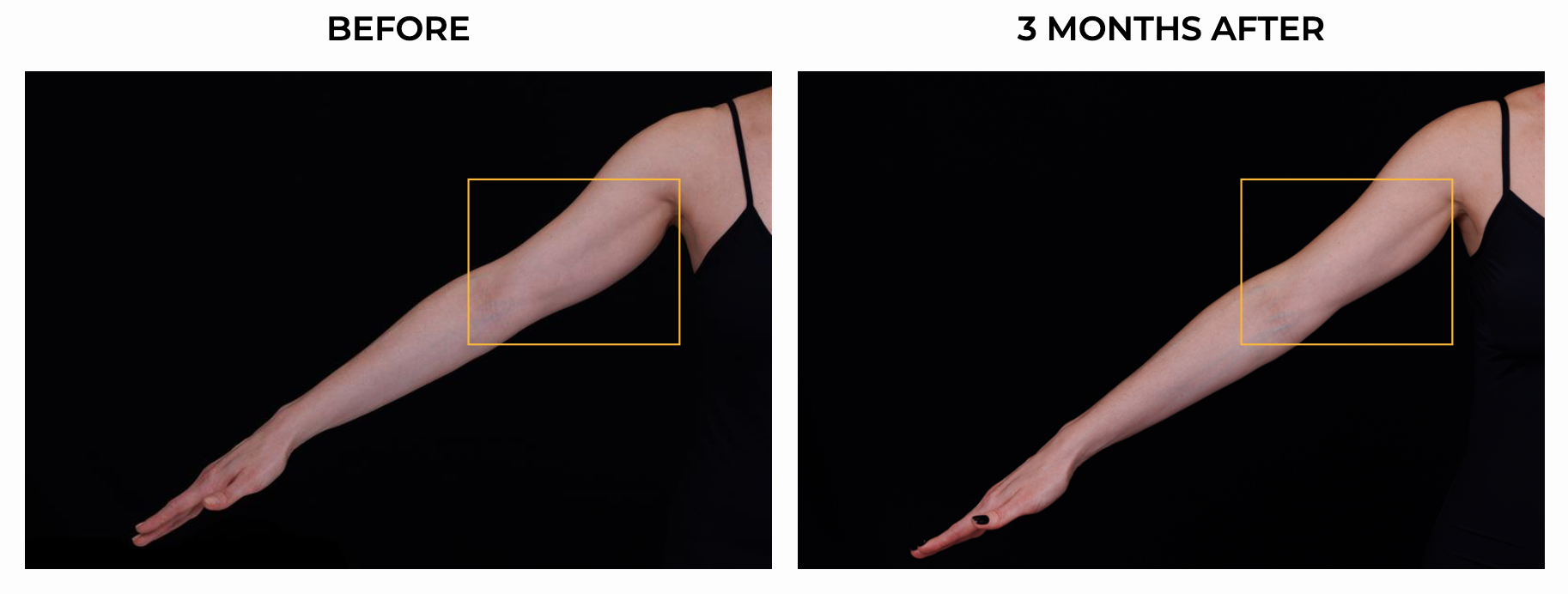 BA ULTHERAPY BODY 3.png