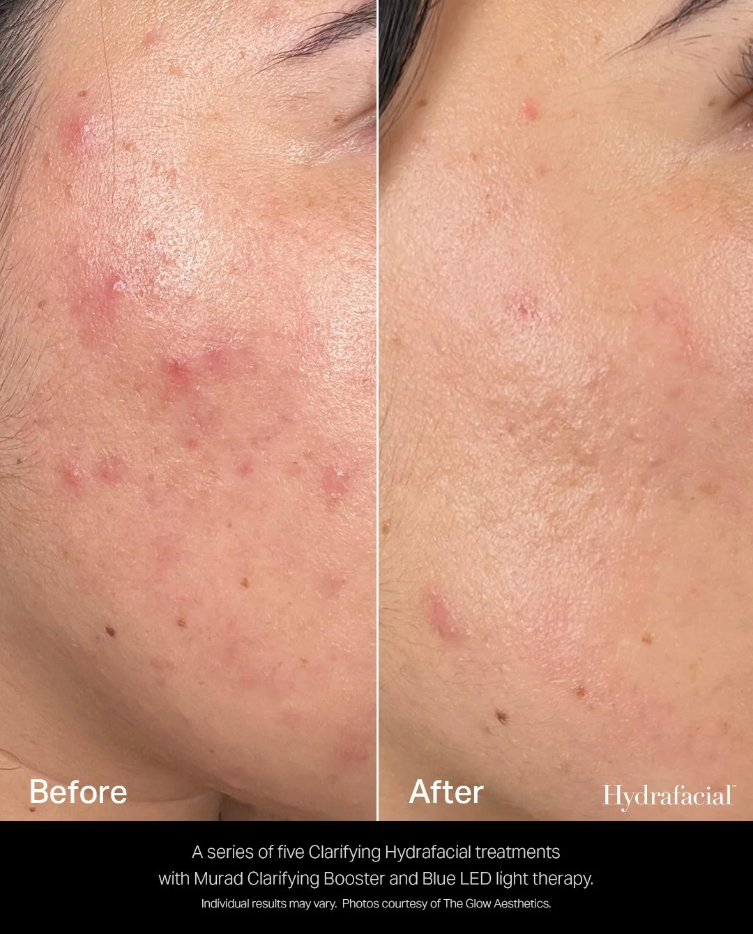 B/A HYDRAFACIAL