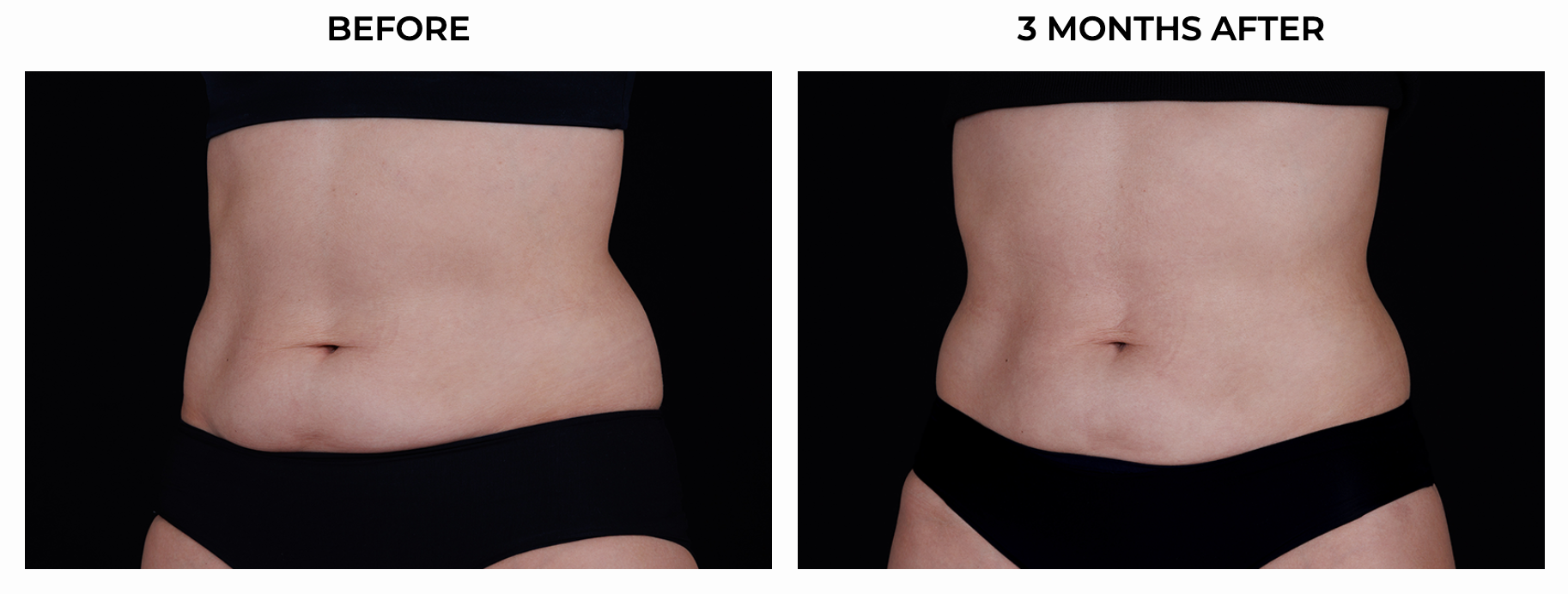 BA ULTHERAPY BODY 4.png