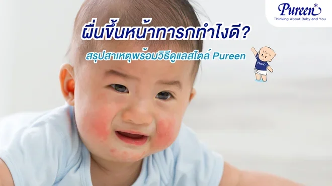 ผื่นขึ้นหน้าทารกทำไงดี Pureen มีวิธีดูแลผิวลูกน้อย