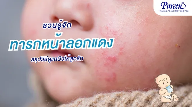 ทารกหน้าลอกแดง วิธีดูแลผิวบอบบางให้ลูกอย่างถูกวิธี