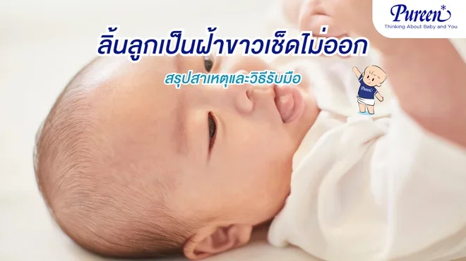 ลิ้นลูกเป็นฝ้าขาวเช็ดไม่ออก สรุปสาเหตุและวิธีรับมือ