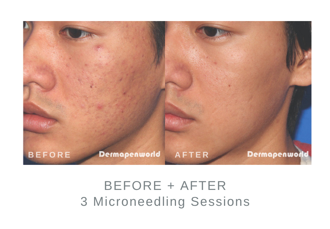 Before and After Microneedling for Acne Scars | DermaEnvy Skincare