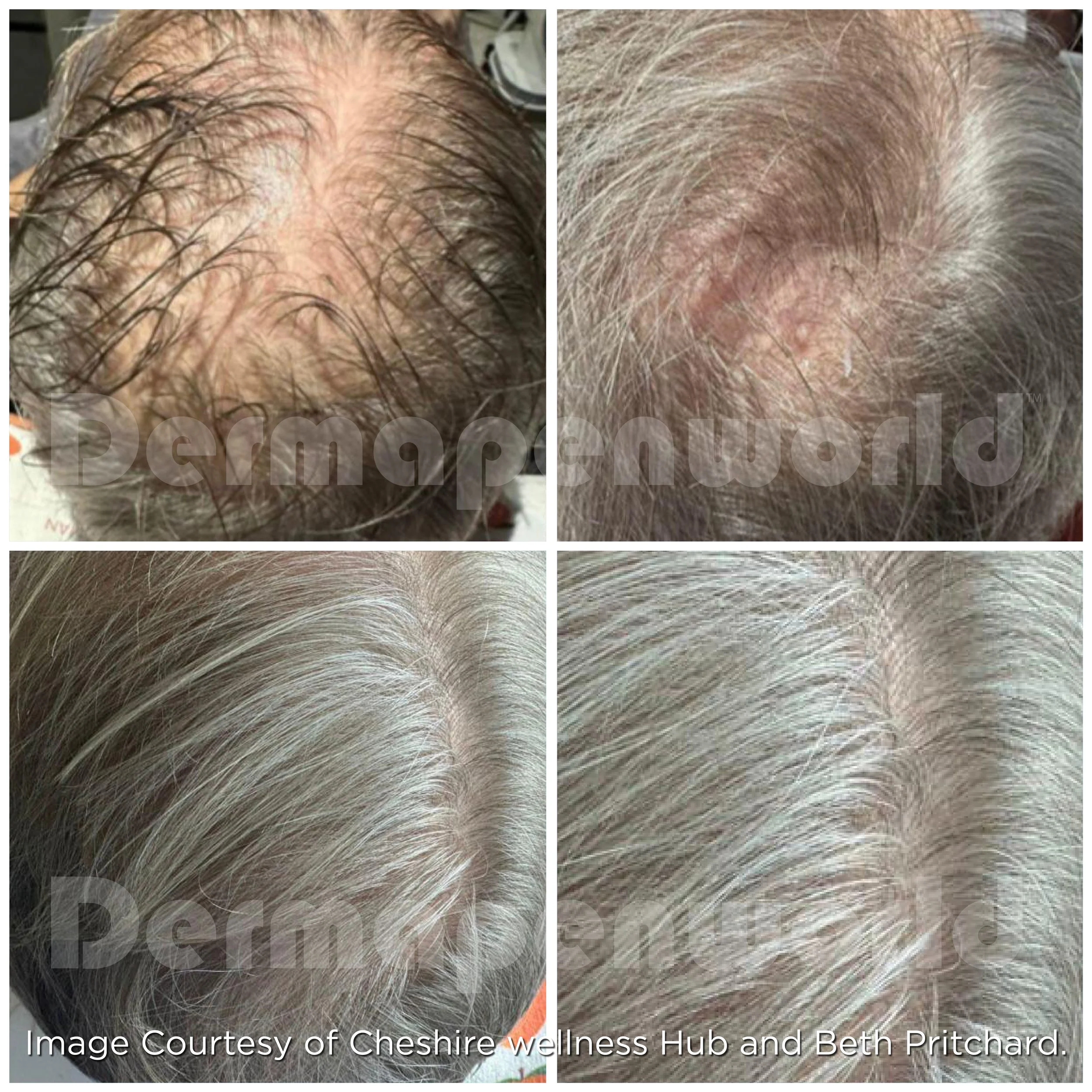 B A30012025 EXO-GROW Before After  (1).jpg