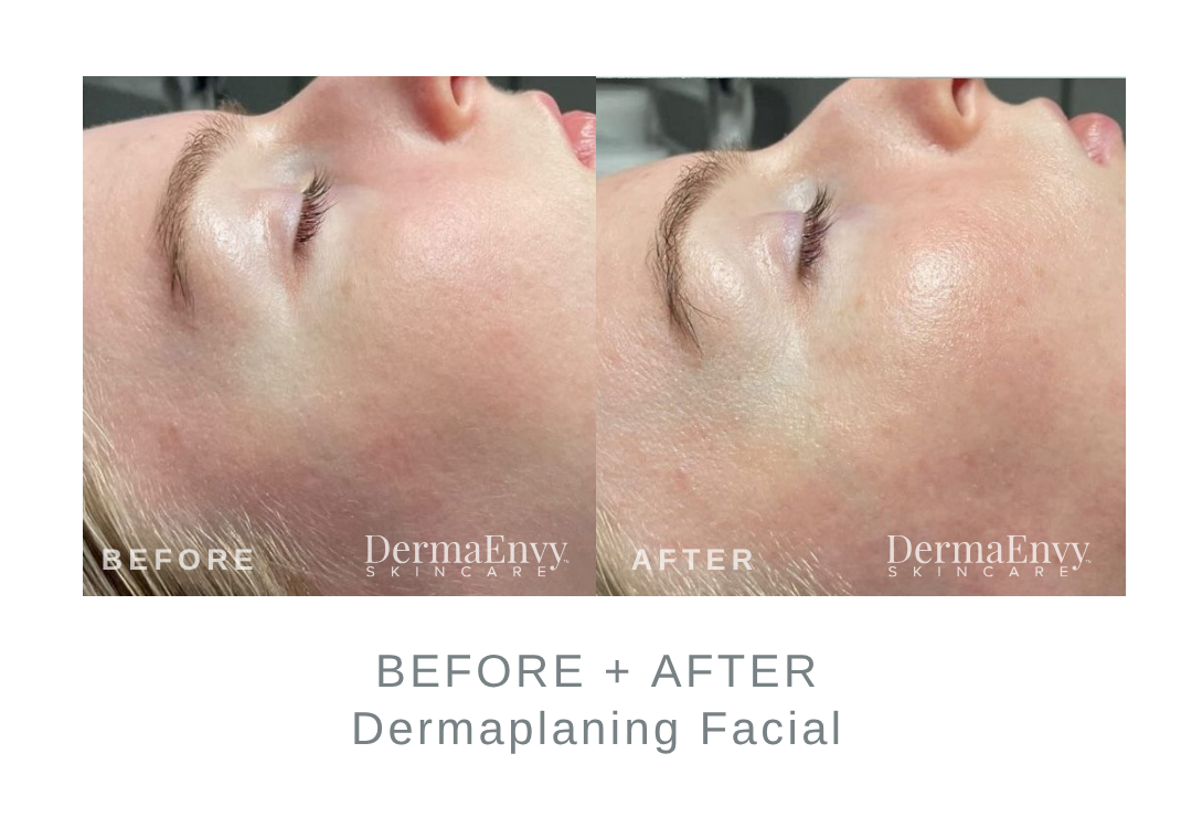 Before and After Dermaplaning Facial | DermaEnvy Skincare 