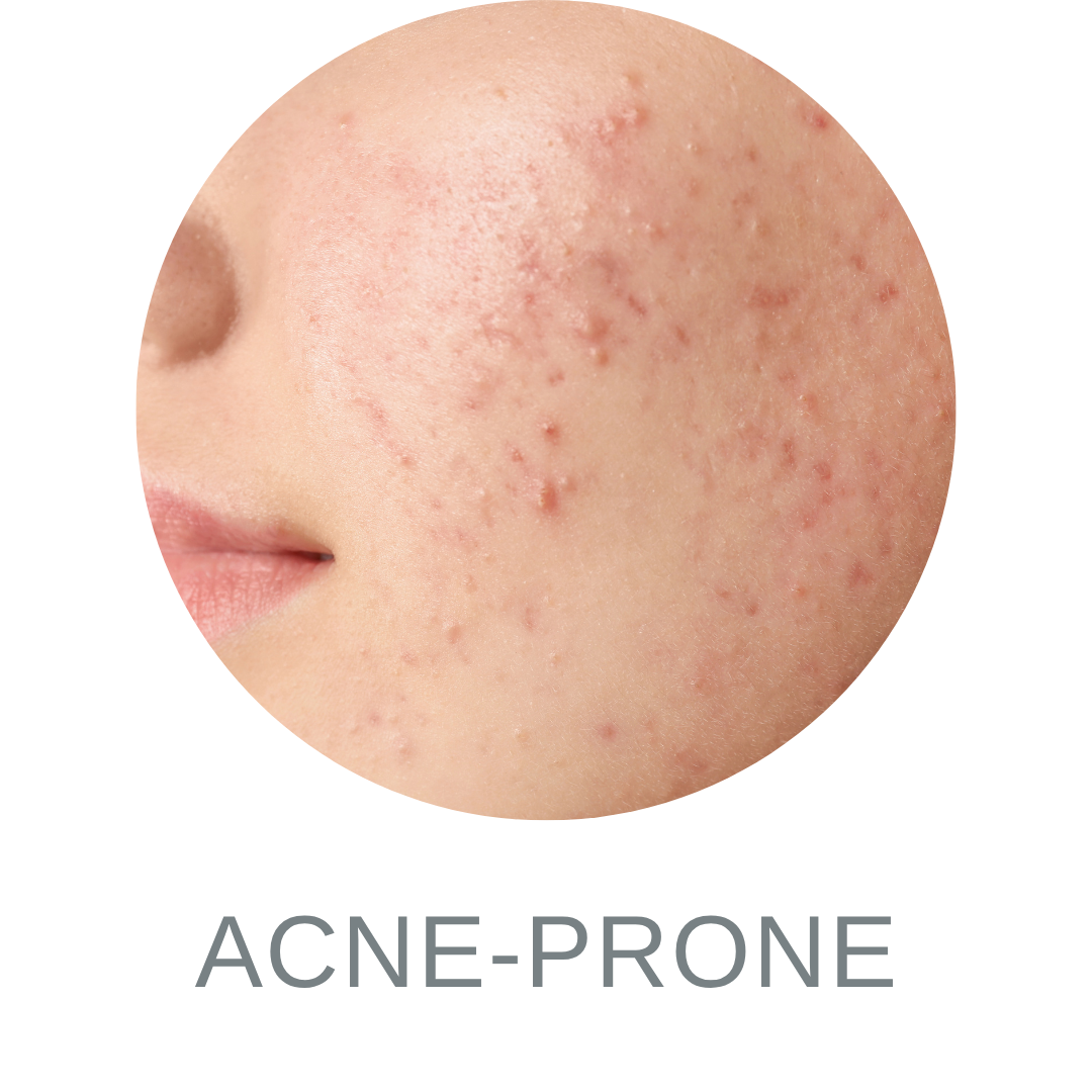 Acne Prone Skin 