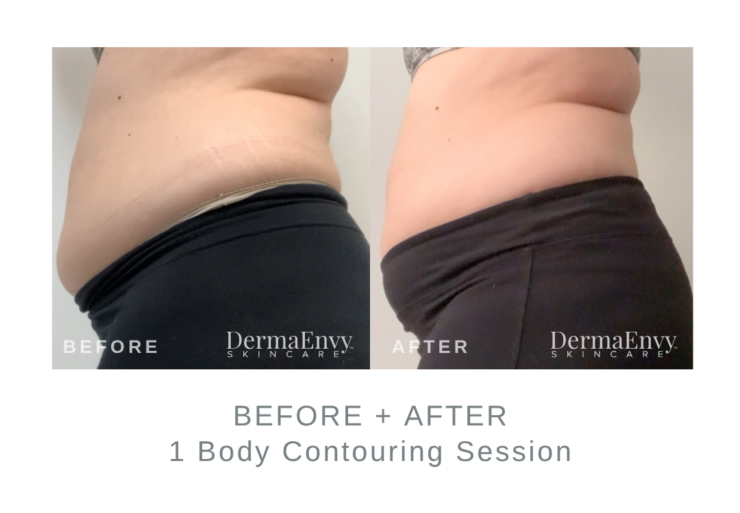 Before and After Body Contouring | DermaEnvy Skincare