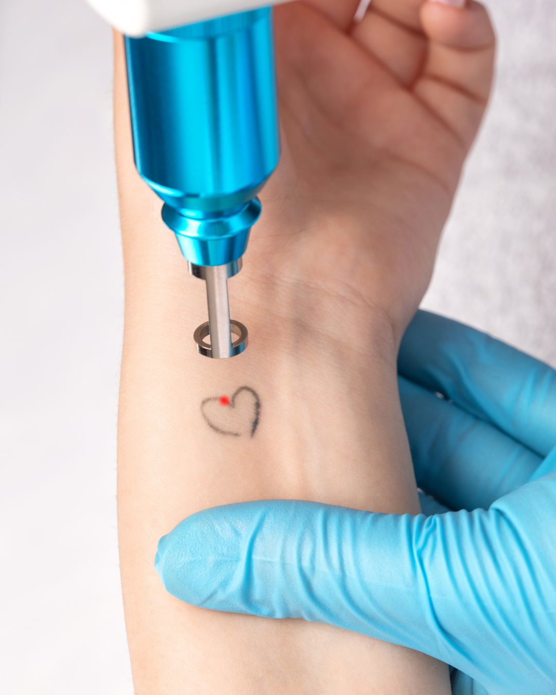 Who is a good tattoo removal candidate DermaEnvy Skincare
