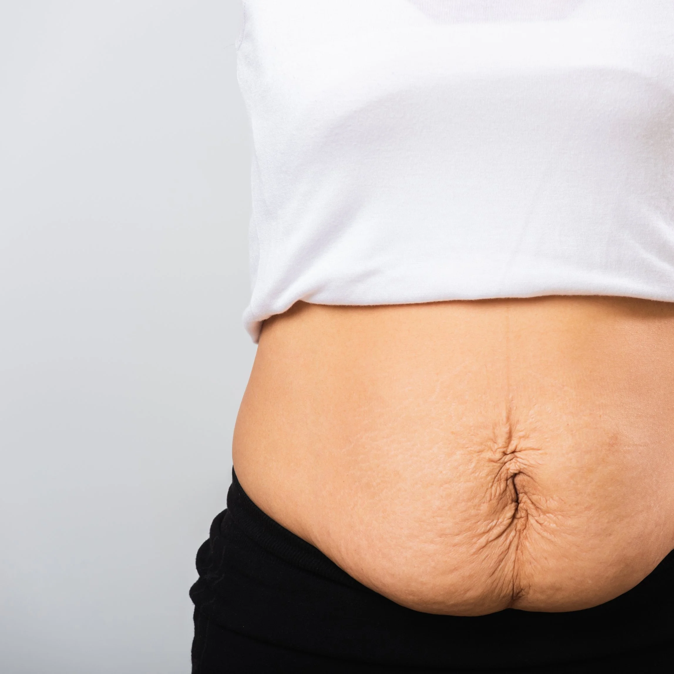 Loose Skin After Ozempic: Why It Happens and What Skin Tightening Can Do