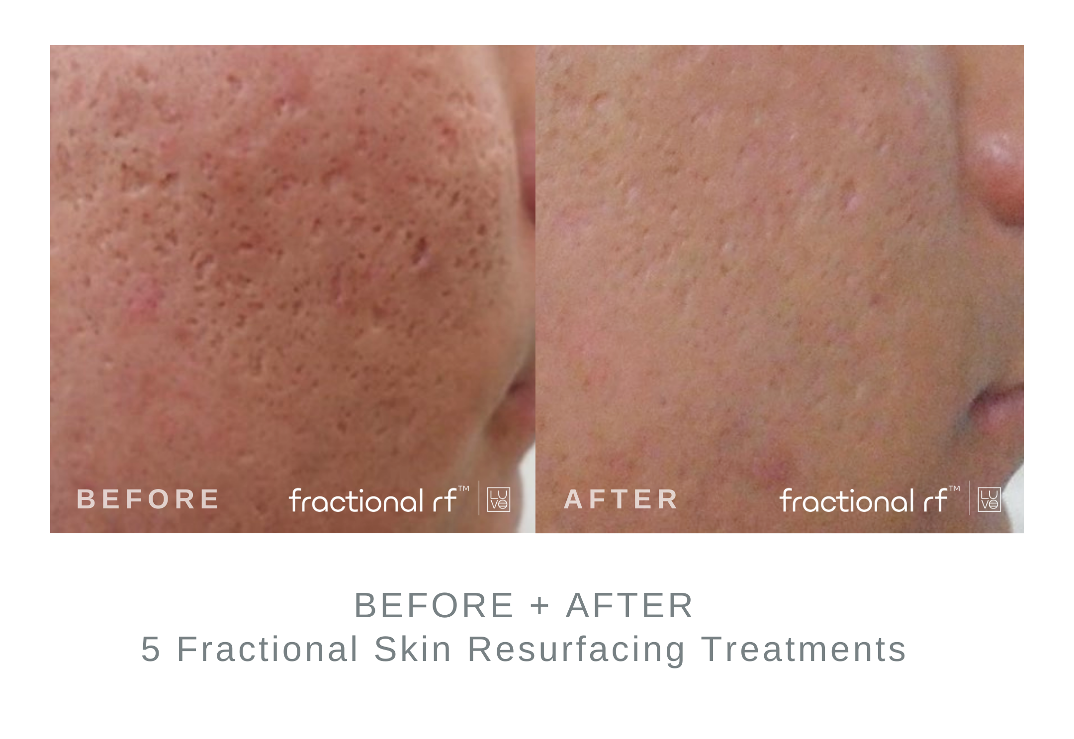 Fractional+Resurfacing+Before+and+After.png