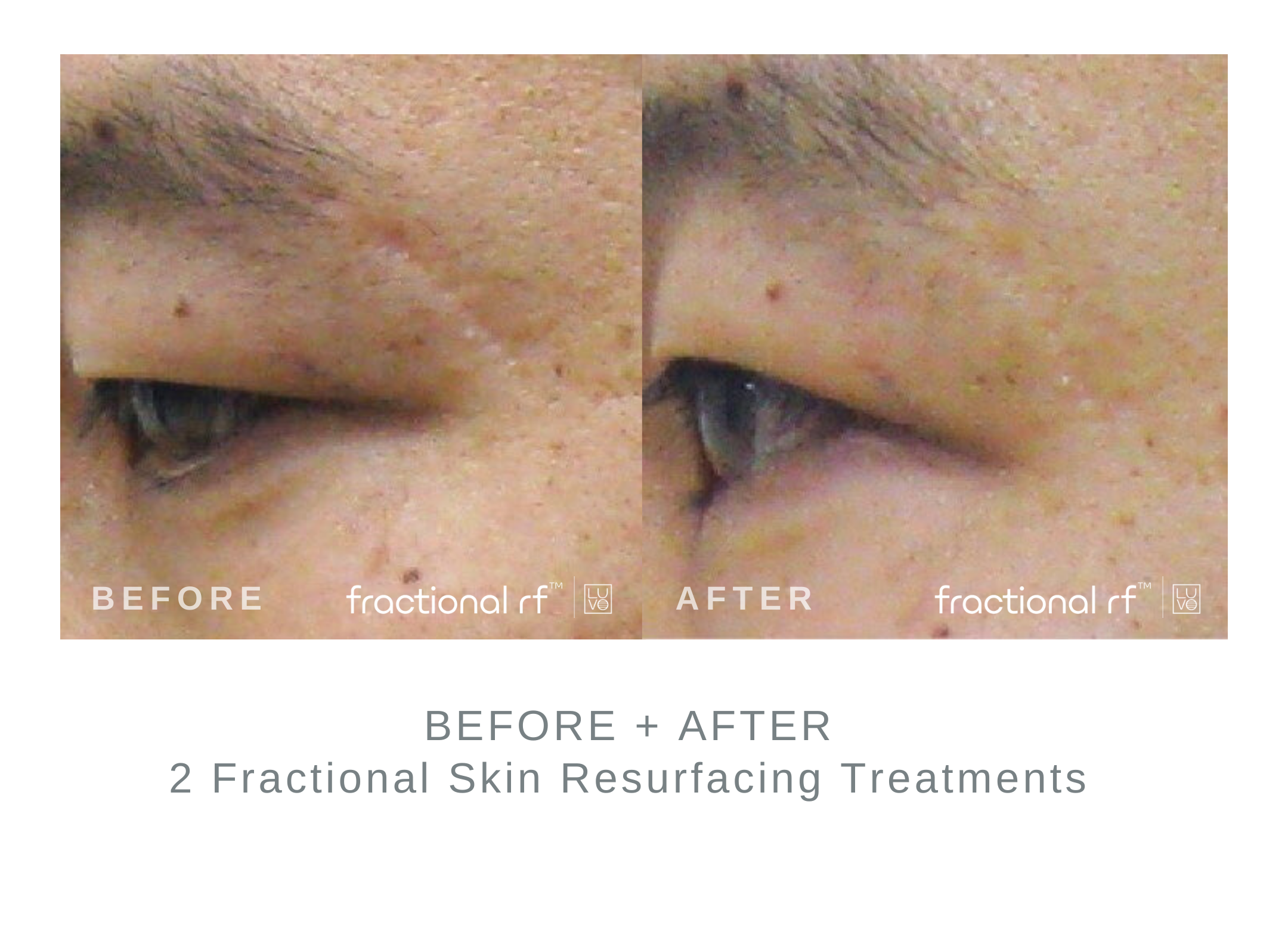 Before+and+After+2+Fractional+Resurfacing+Treatments.png