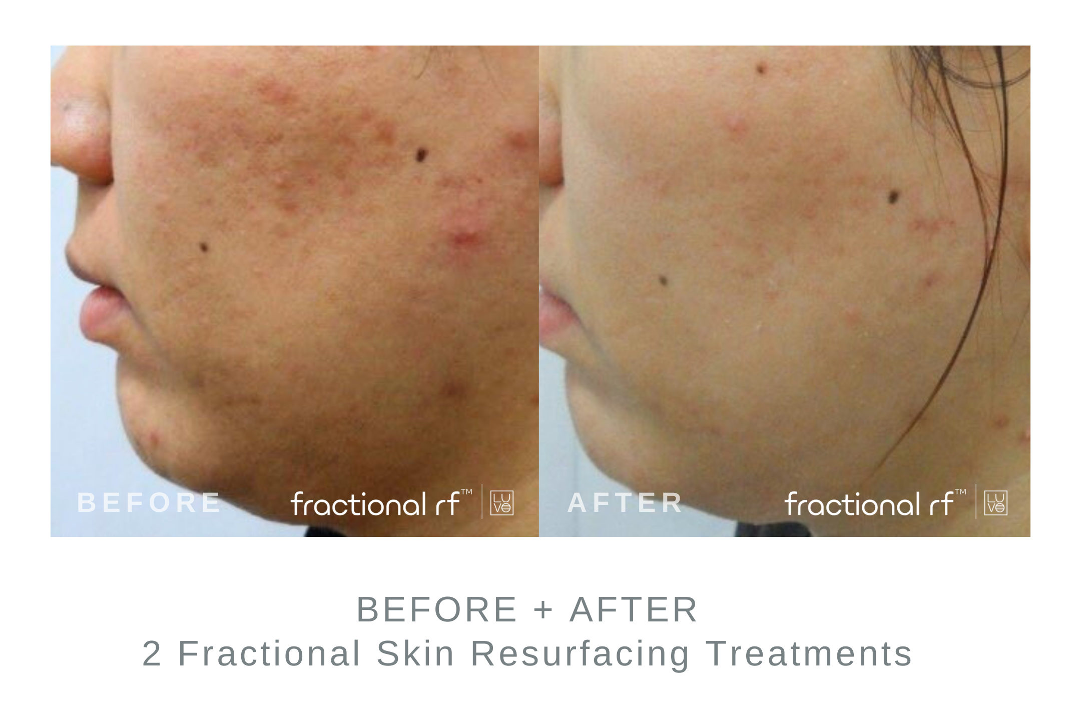 Before+and+After+2+Fractional+Resurfacing+Treatments+for+Acne.png