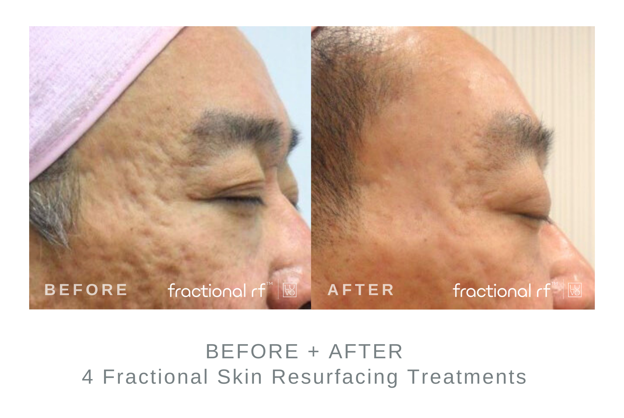 Before+and+After+4+Fractional+Resurfacing+Treatments.png
