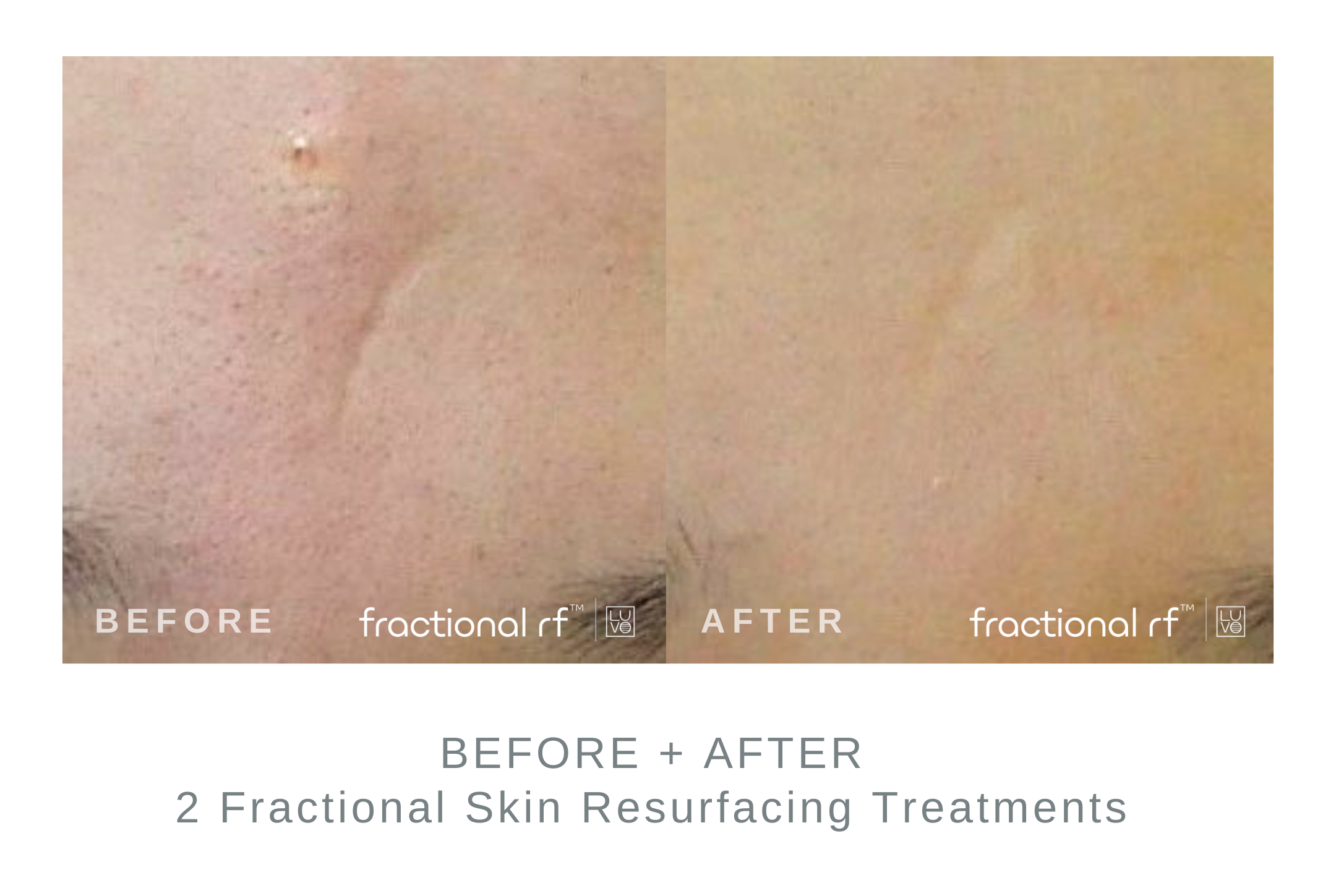 Fractional+Resurfacing+2+Treatments.png