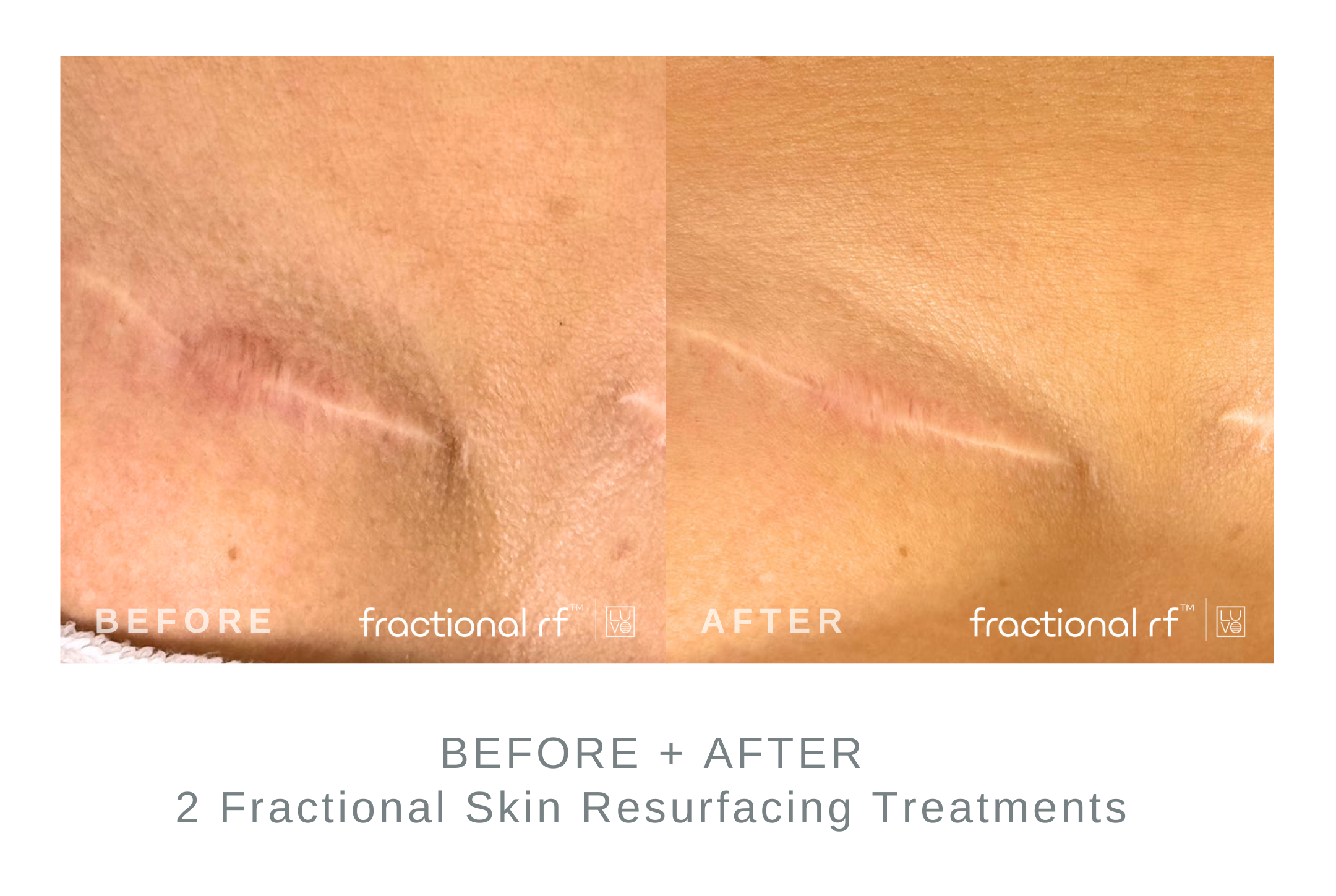 Scar+Reductio+with+Fractional+Resurfacing.png