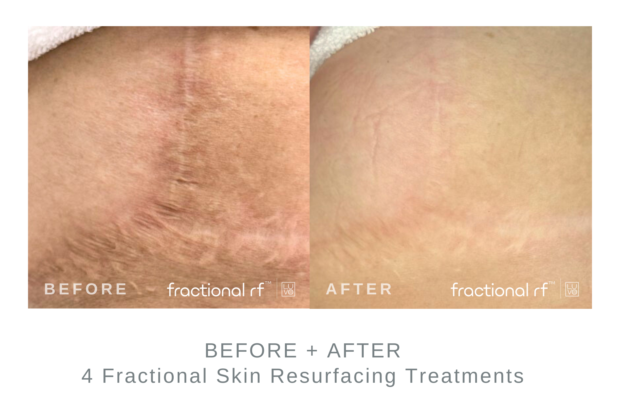 Fractional+Skin+Resurfacing+Website+Images2252.png
