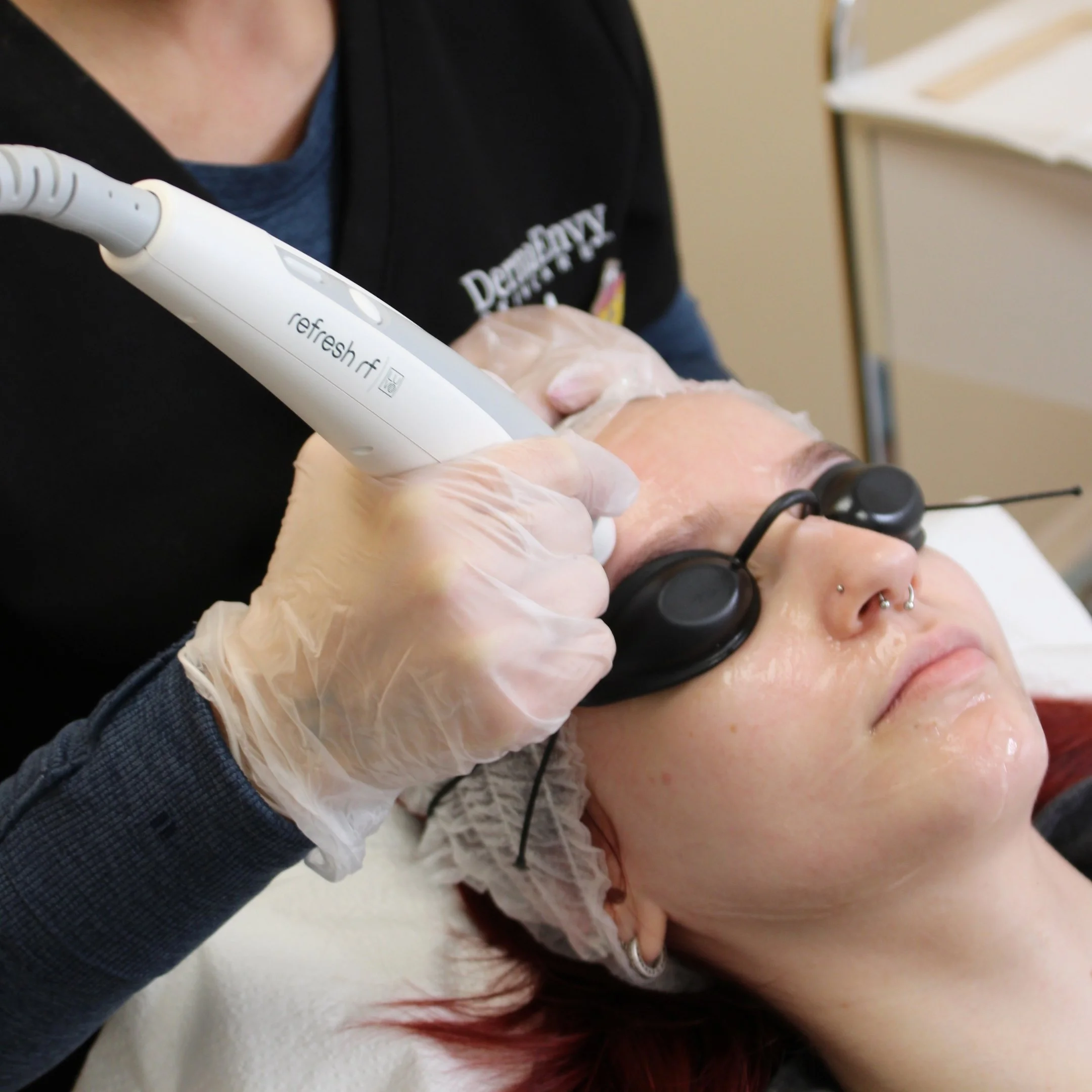 Fractional RF Skin Resurfacing: The Ultimate Spring Skin Reset