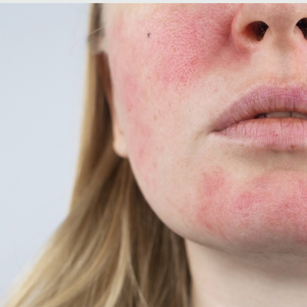 How to Treat Rosacea: Causes, Triggers &amp; The Most Effective Treatment Options