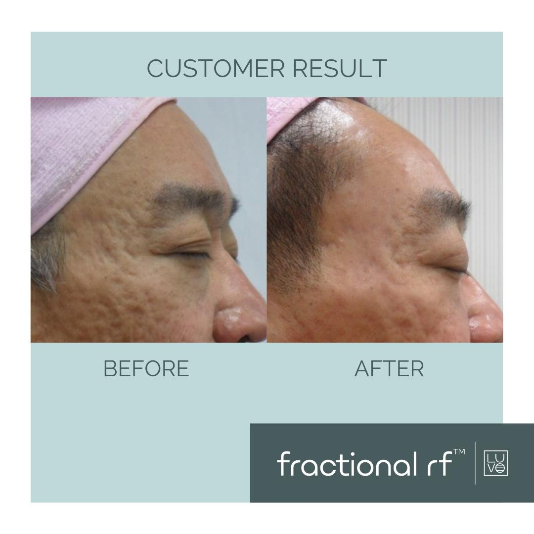 Fractional Skin Resurfacing vs Laser Resurfacing: What’s the Difference?