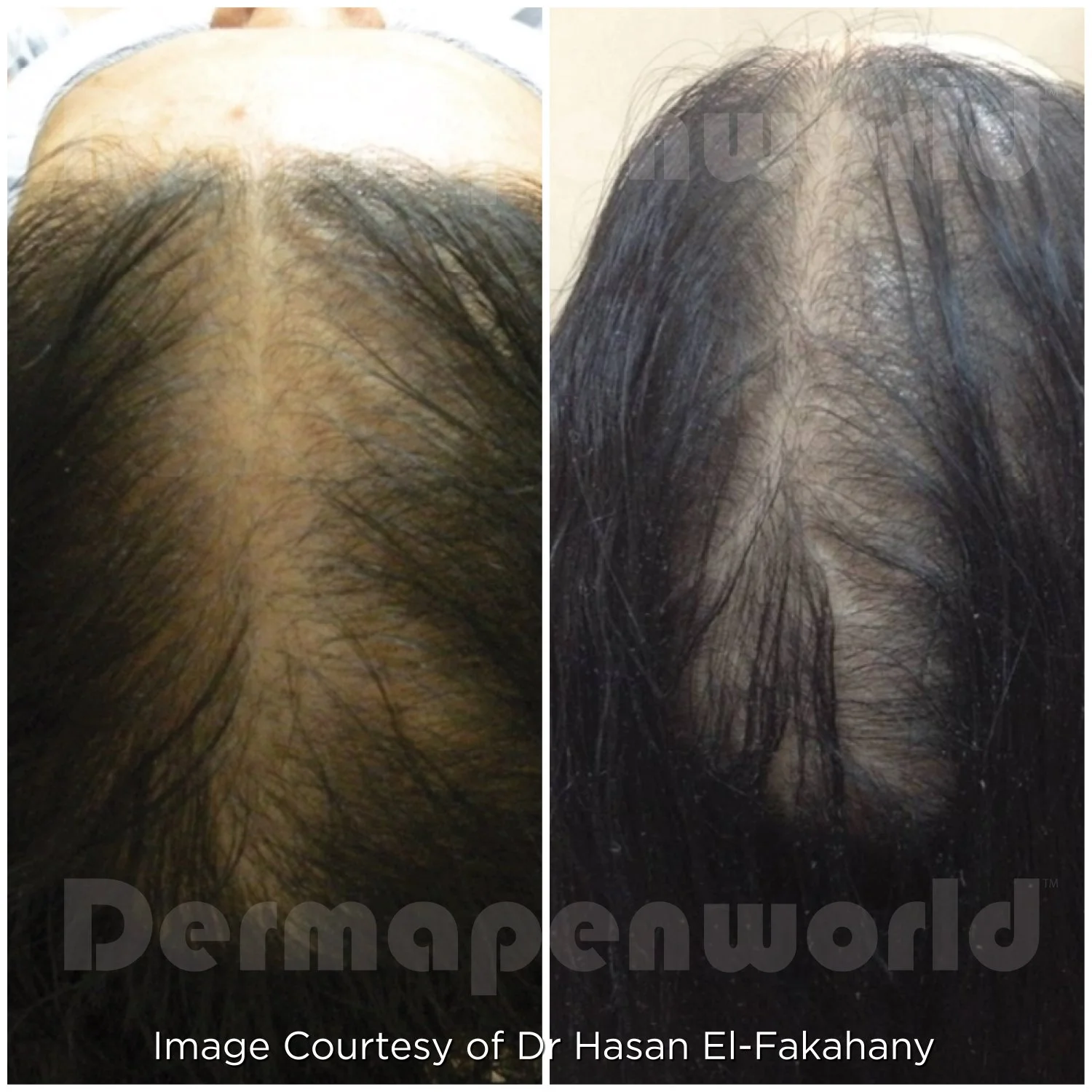 Natural Solutions for Hair Loss: A Science-Backed, Non-Invasive Approach to Thicker, Healthier Hair