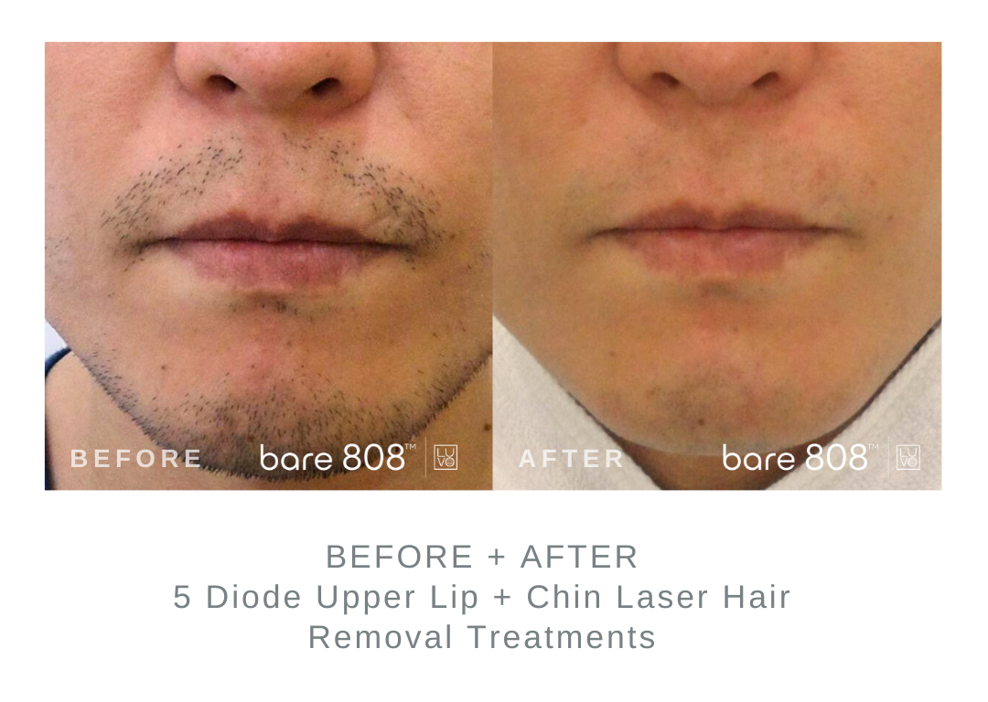 Before and After Chin and Upper Lip Laser Hair Removal