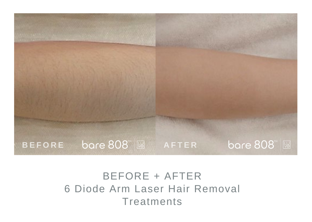 Before and After Arm Laser Hair Removal