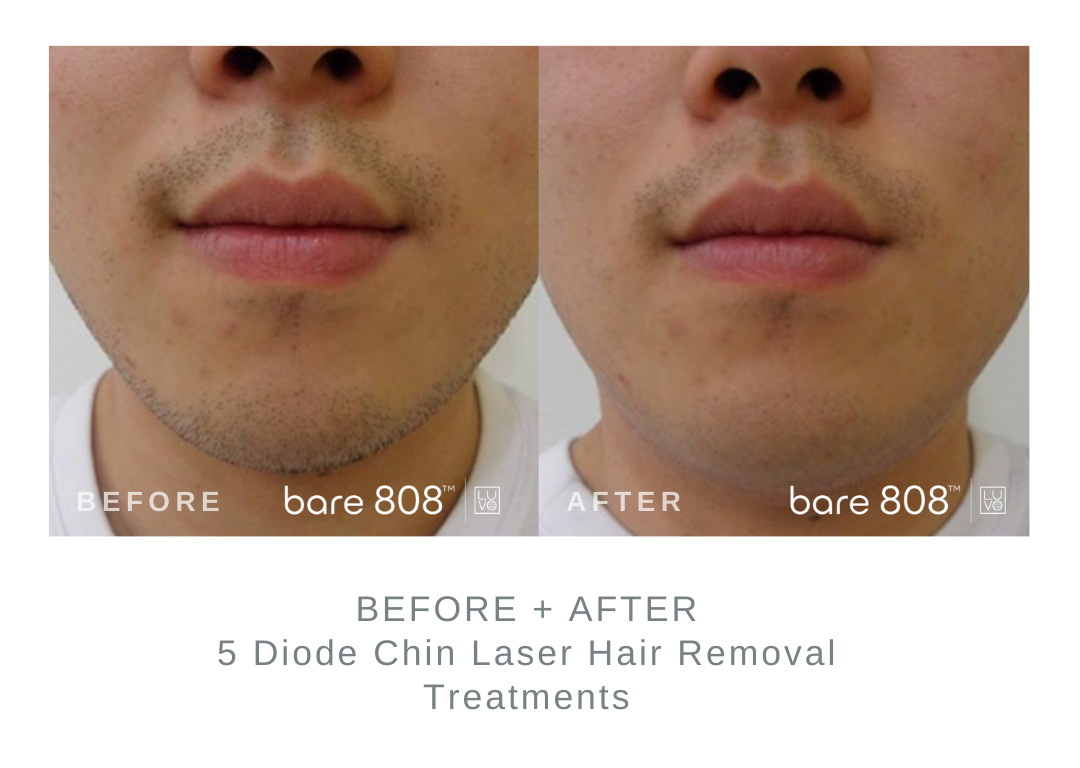 Before and After Chin Laser Hair Removal 